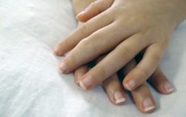 Juvenile arthritic hands