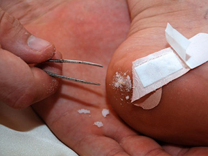 Baking Soda for a Splinter Baking Soda for a Splinter